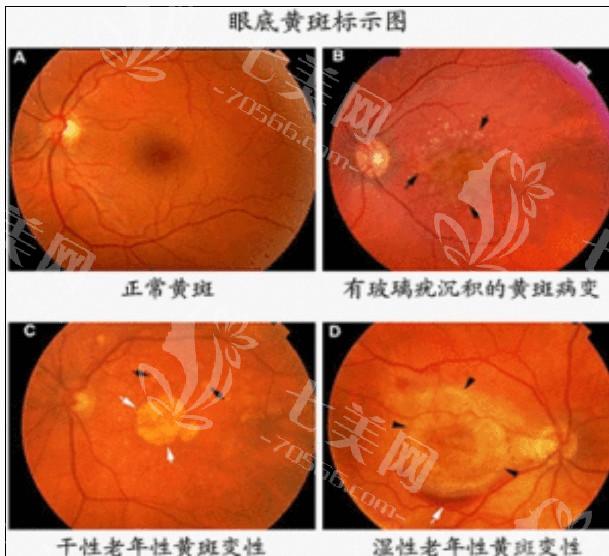 安排杭州眼科医院白内障手术收费价格 双焦点晶体16800起，收费透明不坑人