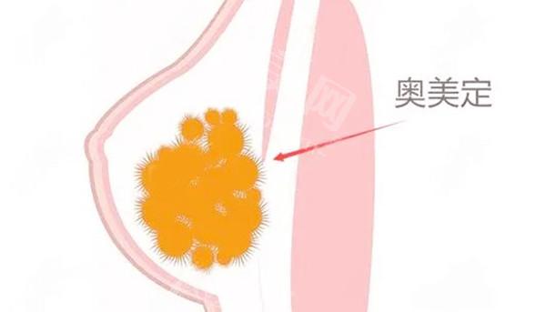 2024清奥手术收费标准更新,是国内奥美定取出正规且干净整形医院报价