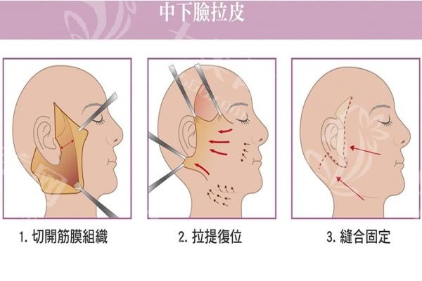 筋膜悬吊手术按照手术部位/手术方式多少钱一次？一般价格在8000~60000元不等哦