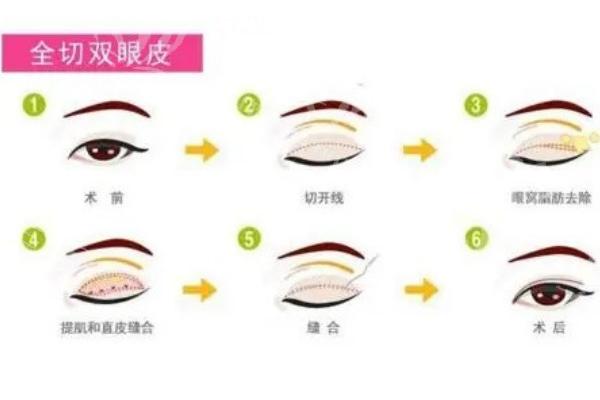 广州华美林晓燕眼综合价格1.3w起:做眼睛口碑好价格合理审美漂亮