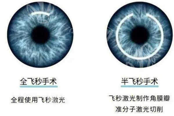 深圳全飞秒手术报价多少钱?近视眼手术价格15800起详细费用看手术方式及近视度数